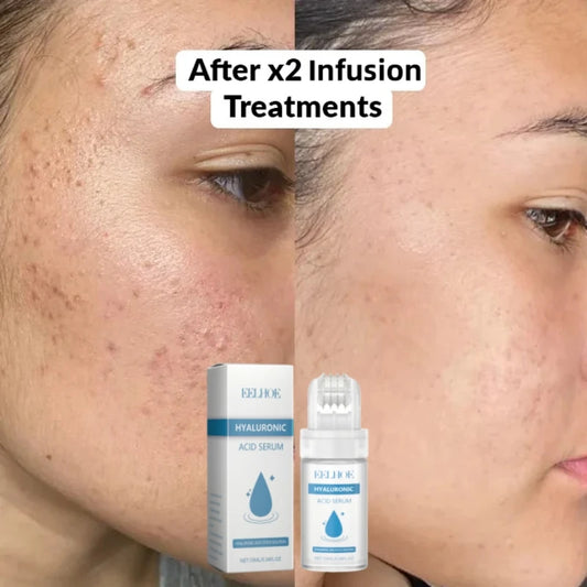Hyaluronic Acid Face Serum Micro Infusion System Hydrating Serum,Firming Facial Skin.Collagen Women's Beauty and Health Products